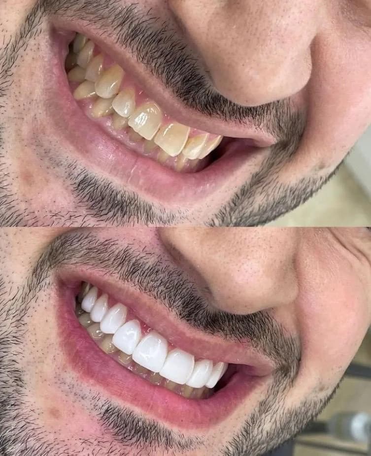 Comparación clínica antes y después de un diseño de sonrisa