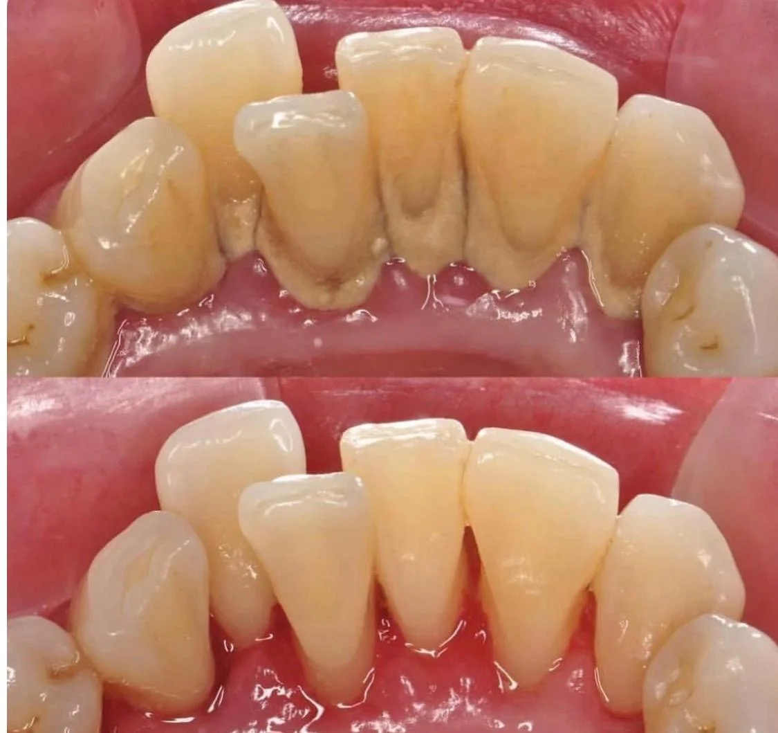 Antibióticos antes del dentista: quiénes sí los necesitan y quiénes no